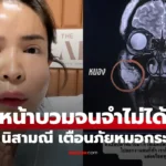 นัท นิสามณี เตือนภัยฉีดหน้าหมอกระเป๋า ระเบิดเวลา 10 ปี