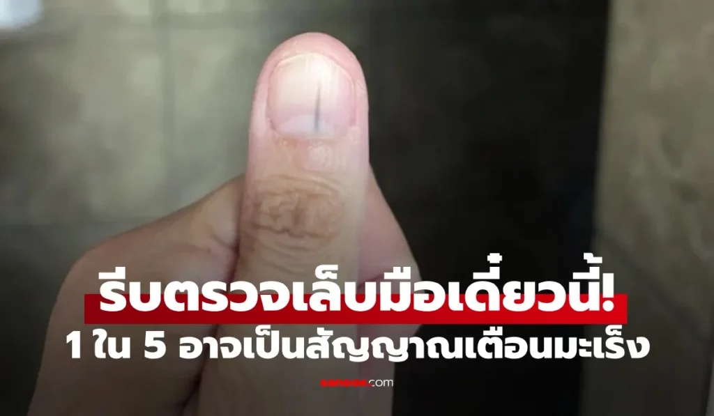 5 สัญญาณมะเร็งร้าย ที่ “เล็บมือ” ส่งสัญญาณเตือน แต่คนมองข้าม