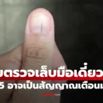 5 สัญญาณมะเร็งร้าย ที่ “เล็บมือ” ส่งสัญญาณเตือน แต่คนมองข้าม