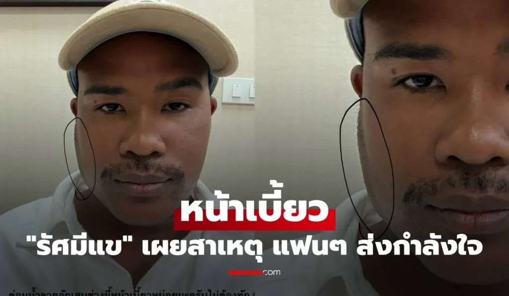 รัศมีแข เผยภาพหน้าเบี้ยว พร้อมสาเหตุที่ชัดเจน แฟนๆส่งกำลังใจ